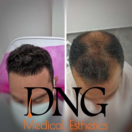 dng5