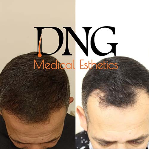 dng6